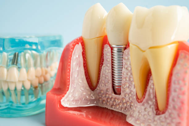 Best Wisdom Tooth Removal  in Washington, GA